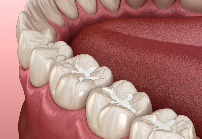 Illustrated row of teeth with white fillings