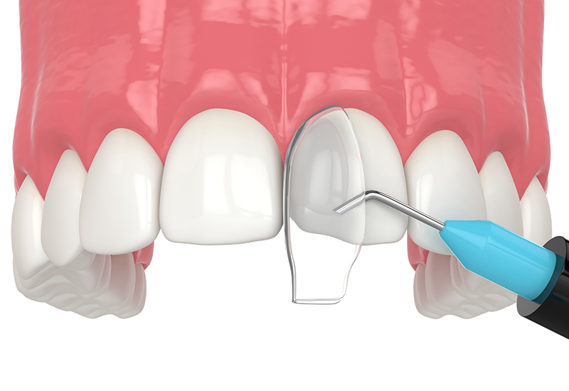 Illustration of a dental instrument applying bonding material to a chipped tooth