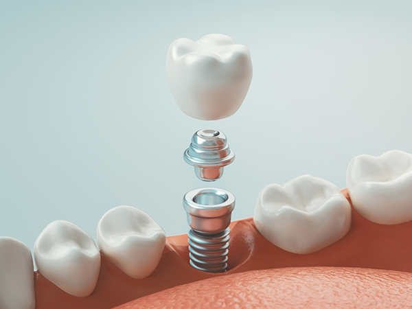 Illustrated dental implant replacing a missing lower tooth