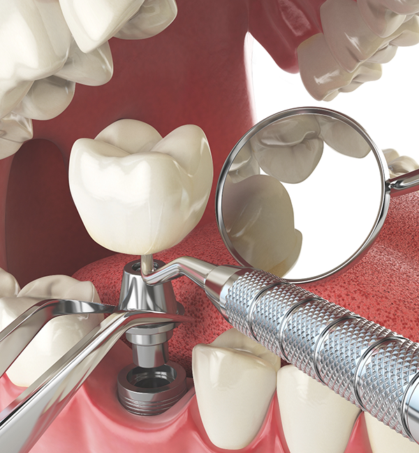 Illustrated dental implant with abutment and crown being placed in the lower jaw