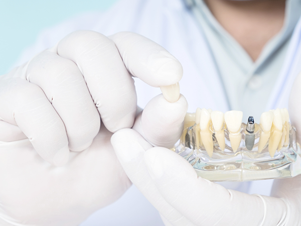 Dentist holding a dental crown next to a model of the mouth with a dental implant