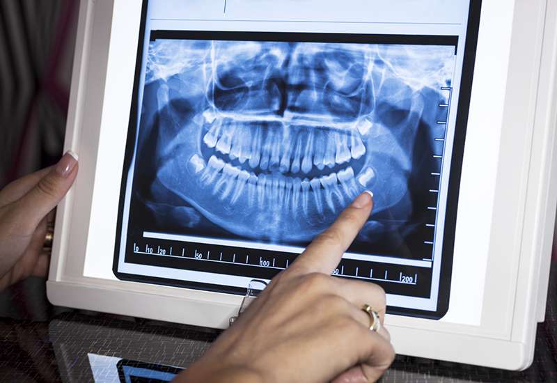 Person pointing to a screen showing an x ray of teeth