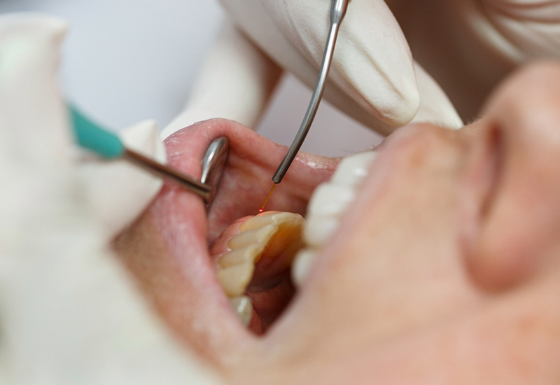 Close up of a dental patient having their gums treated with a laser