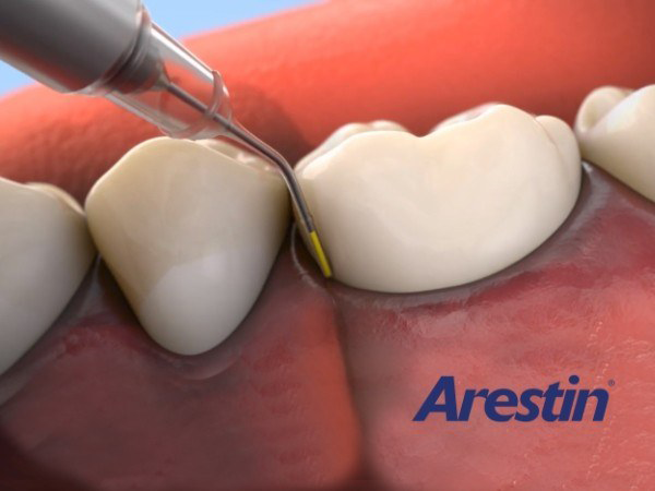 Illustration of Arestin antibiotic being applied to the gums