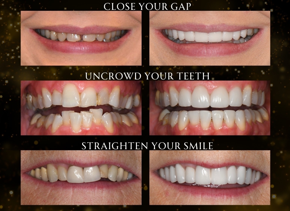 Three close ups of smiles before and after Invisalign treatment