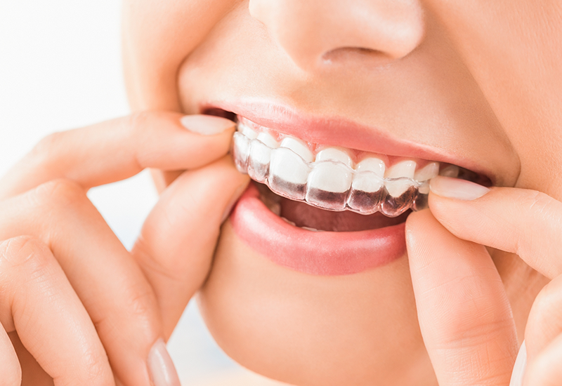 Close up of a person placing an Invisalign tray over their teeth