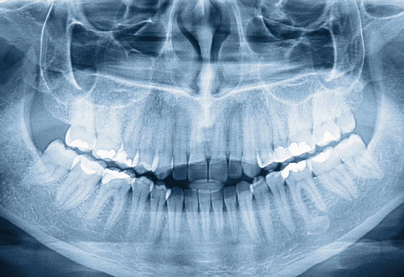 X ray of a persons teeth