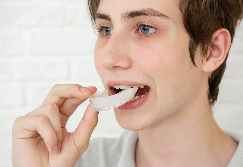 Young man placing a nightguard over his teeth