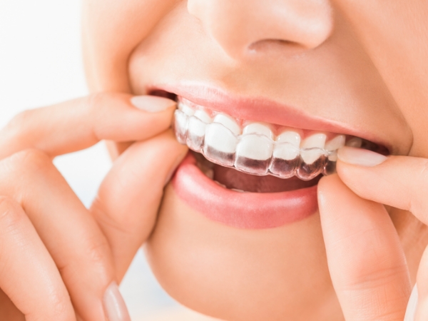 Close up of a person placing an Invisalign aligner over their teeth