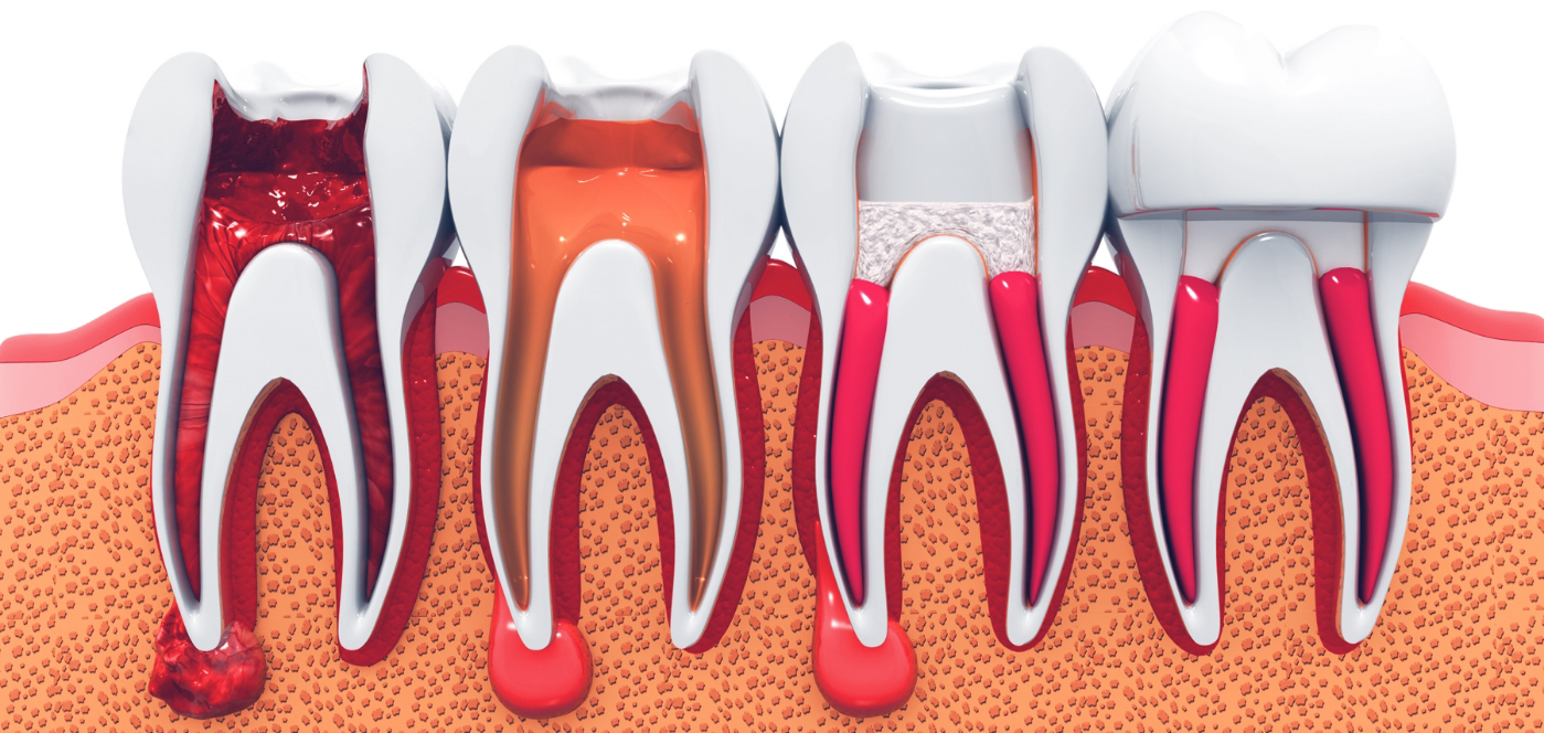 Model of a damaged tooth needing root canal treatment in Wauwatosa