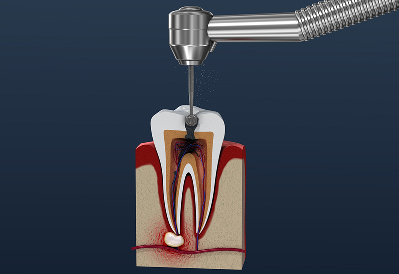 Illustration of a dental instrument treating the inside of a tooth